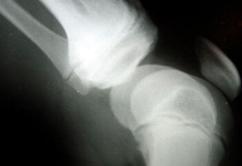 Knee Injury in Car Accident