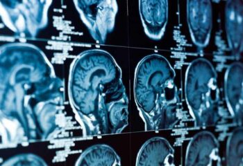 Brain Injury