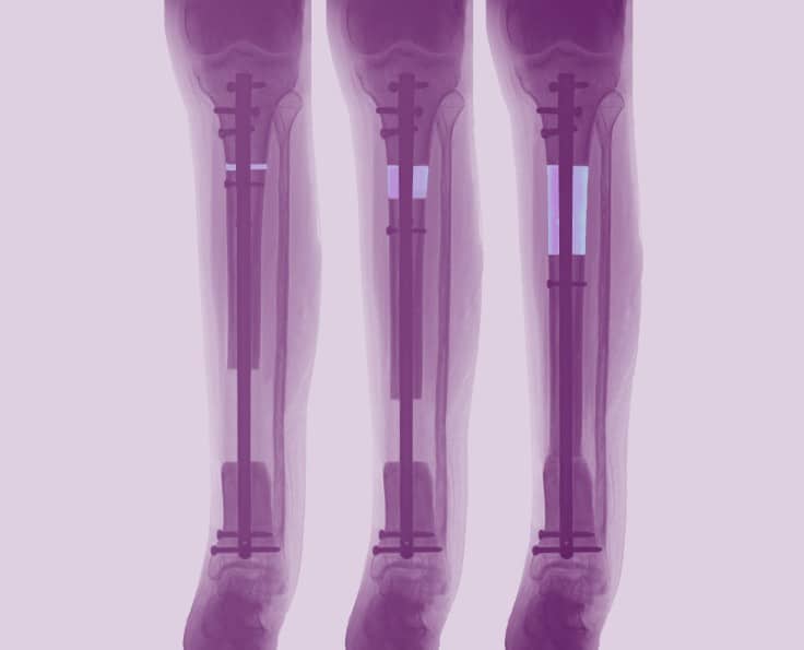 nuvasive precice stryde, plate, and bone transport systems